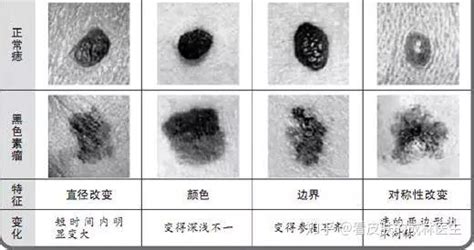 陰囊 黑痣|阴囊包皮处有很多黑痣恶变的几率大吗